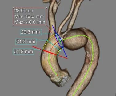 斑马导丝是治疗什么的「胸有乾坤」至简至易 行之有效—— Zone 0 TBE植入治疗弓部动脉瘤病例报道_https://www.jmylbn.com_新闻资讯_第8张