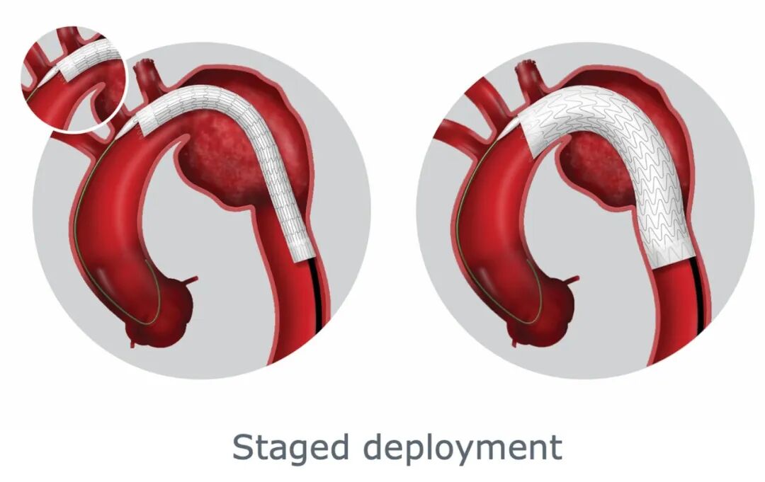 斑马导丝是治疗什么的「胸有乾坤」至简至易 行之有效—— Zone 0 TBE植入治疗弓部动脉瘤病例报道_https://www.jmylbn.com_新闻资讯_第15张