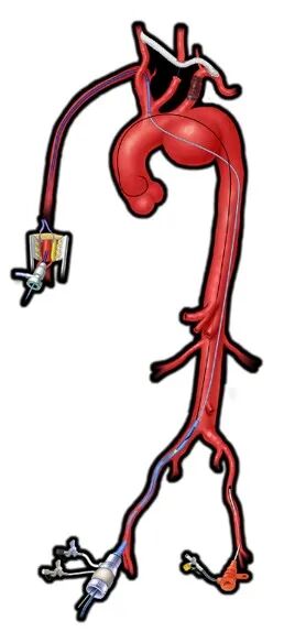 斑马导丝是治疗什么的「胸有乾坤」至简至易 行之有效—— Zone 0 TBE植入治疗弓部动脉瘤病例报道_https://www.jmylbn.com_新闻资讯_第16张