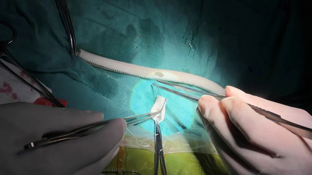 gore医疗怎么样「胸有乾坤」可调可控 从容不迫——GORE® TAG® 可主动调控胸主动脉覆膜支架治疗巨大胸主动脉瘤病例报道_https://www.jmylbn.com_新闻资讯_第13张