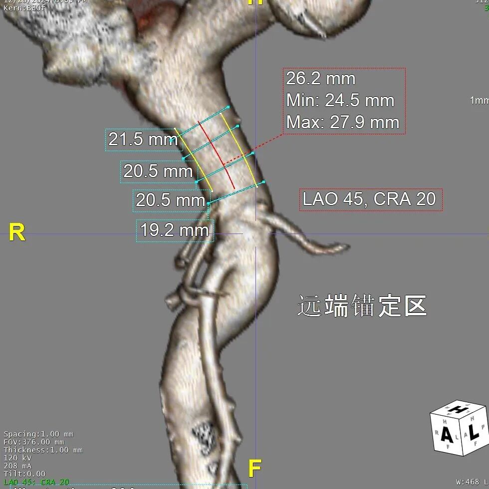 gore医疗怎么样「胸有乾坤」可调可控 从容不迫——GORE® TAG® 可主动调控胸主动脉覆膜支架治疗巨大胸主动脉瘤病例报道_https://www.jmylbn.com_新闻资讯_第10张