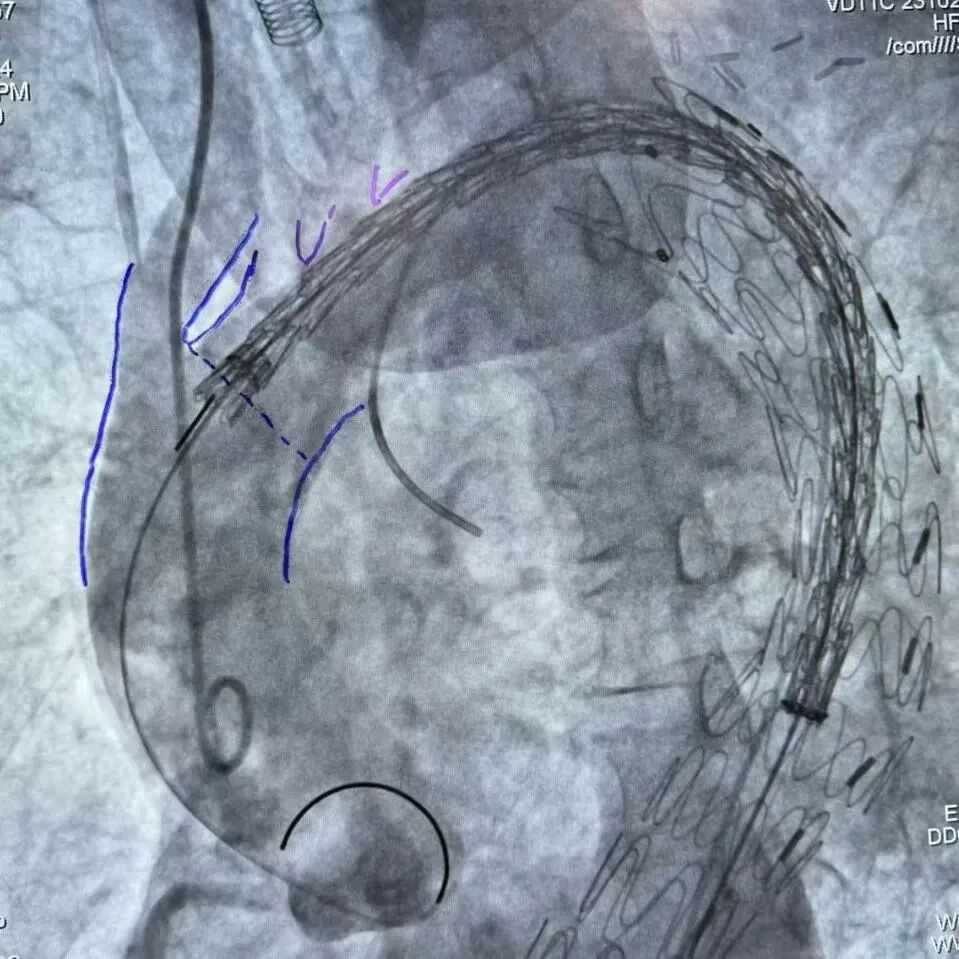 gore医疗怎么样「胸有乾坤」可调可控 从容不迫——GORE® TAG® 可主动调控胸主动脉覆膜支架治疗巨大胸主动脉瘤病例报道_https://www.jmylbn.com_新闻资讯_第24张