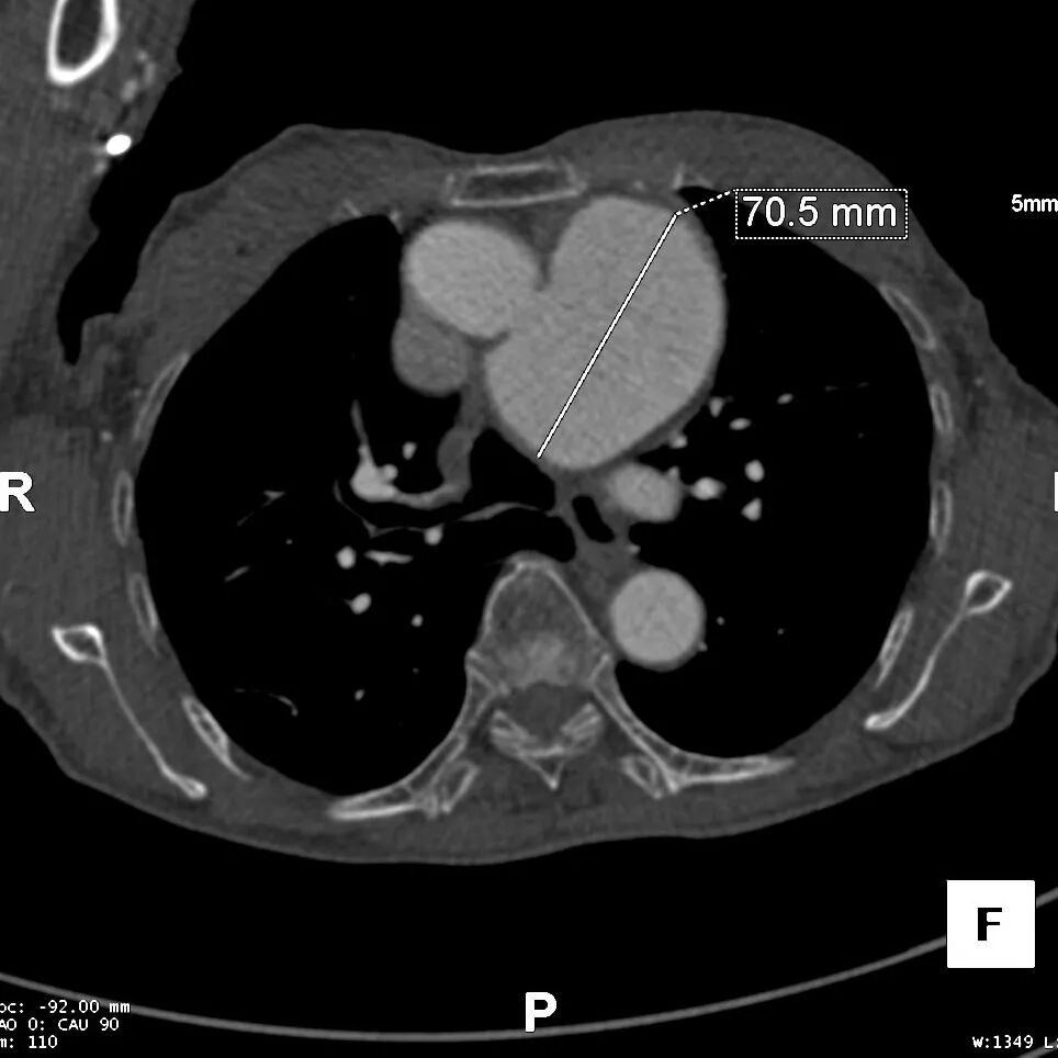 gore医疗怎么样「胸有乾坤」可调可控 从容不迫——GORE® TAG® 可主动调控胸主动脉覆膜支架治疗巨大胸主动脉瘤病例报道_https://www.jmylbn.com_新闻资讯_第8张