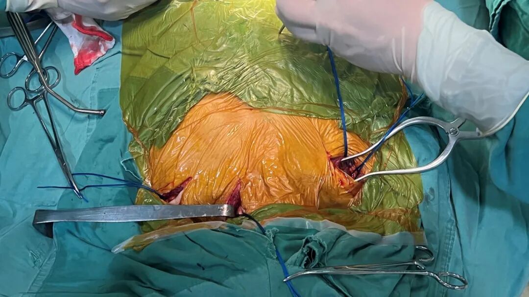 gore医疗怎么样「胸有乾坤」可调可控 从容不迫——GORE® TAG® 可主动调控胸主动脉覆膜支架治疗巨大胸主动脉瘤病例报道_https://www.jmylbn.com_新闻资讯_第12张