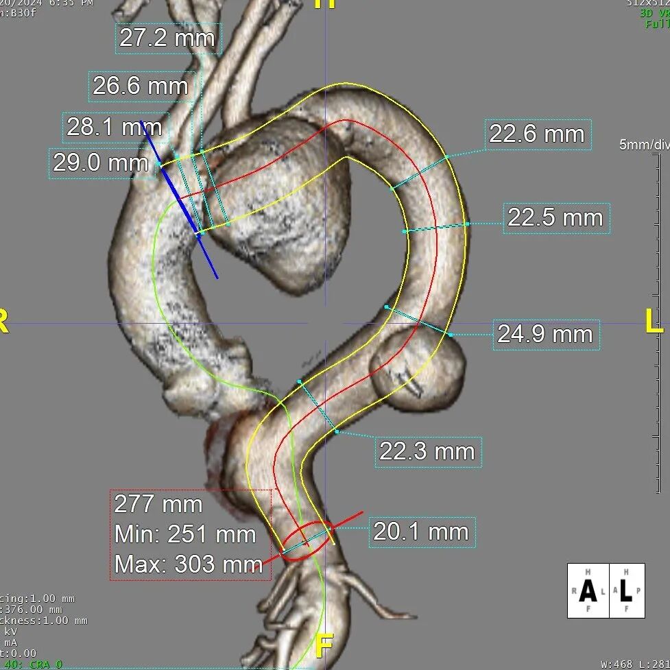 gore医疗怎么样「胸有乾坤」可调可控 从容不迫——GORE® TAG® 可主动调控胸主动脉覆膜支架治疗巨大胸主动脉瘤病例报道_https://www.jmylbn.com_新闻资讯_第11张