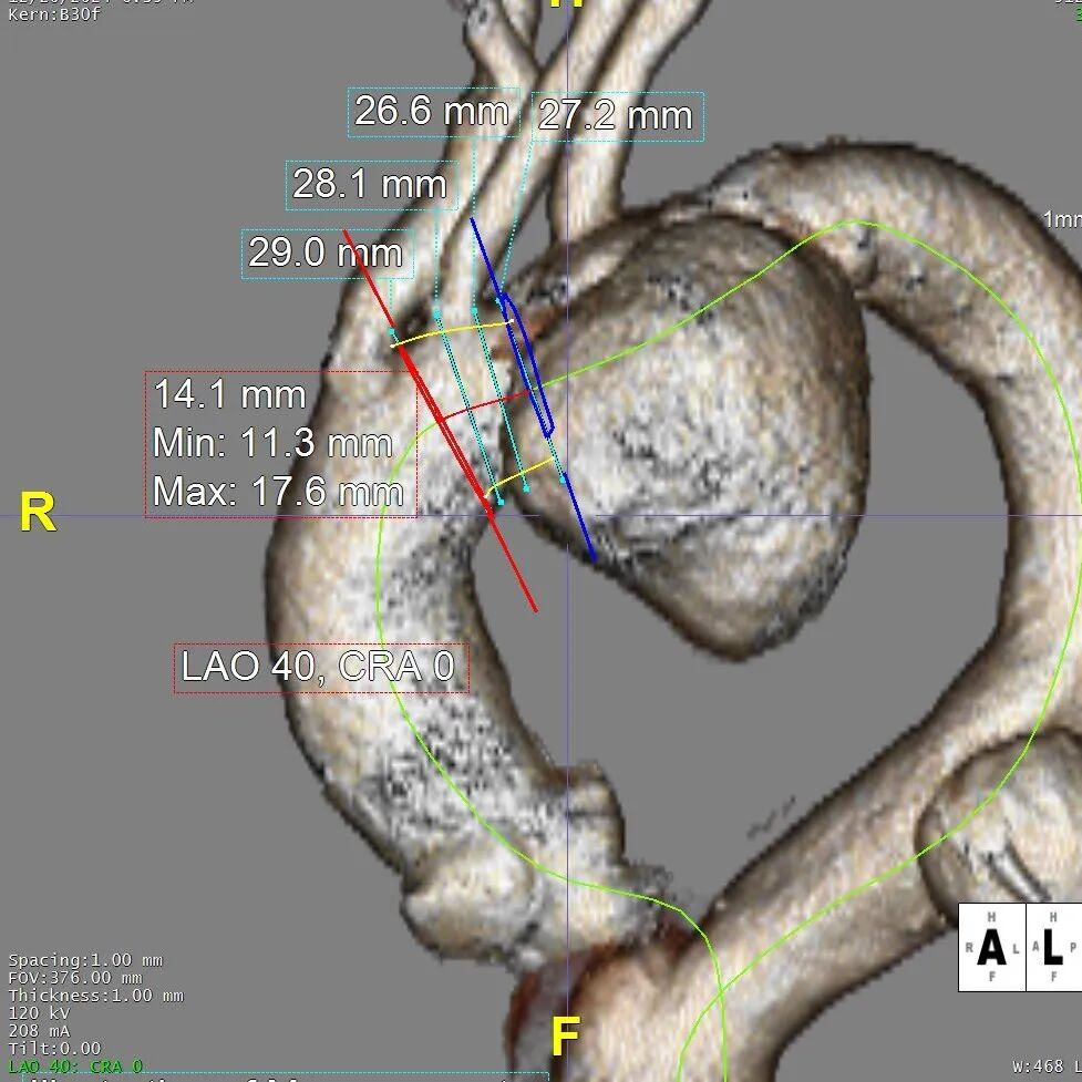 gore医疗怎么样「胸有乾坤」可调可控 从容不迫——GORE® TAG® 可主动调控胸主动脉覆膜支架治疗巨大胸主动脉瘤病例报道_https://www.jmylbn.com_新闻资讯_第9张