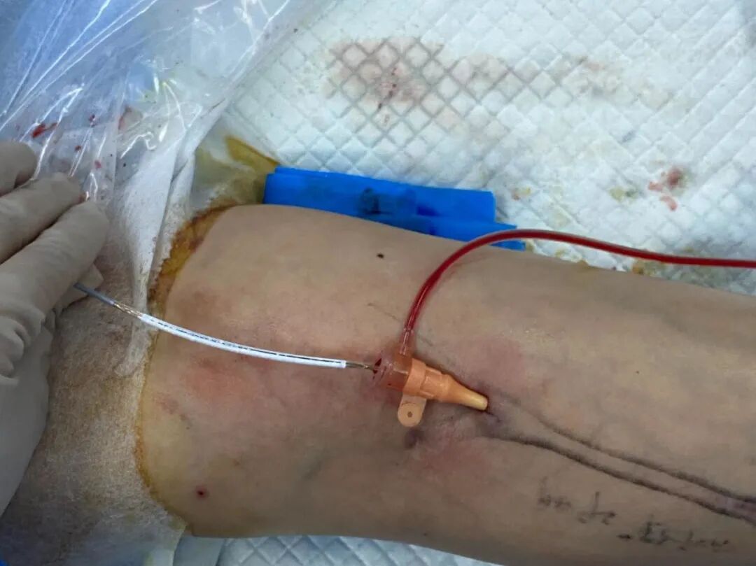 pta在医学上什么意思鼎例相助 ｜ 张和平教授团队：刻痕药涂球囊的应用体会_https://www.jmylbn.com_新闻资讯_第12张