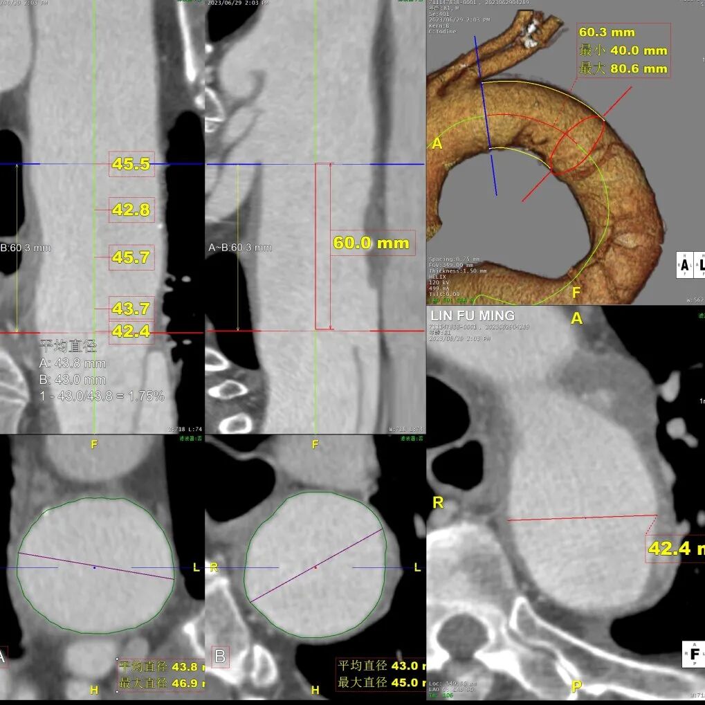 gore医疗怎么样「胸有乾坤」危如累卵 妙手回春——Conformable GORE®TAG®胸主动脉覆膜支架应用于高龄急性主动脉夹层治疗_https://www.jmylbn.com_新闻资讯_第17张