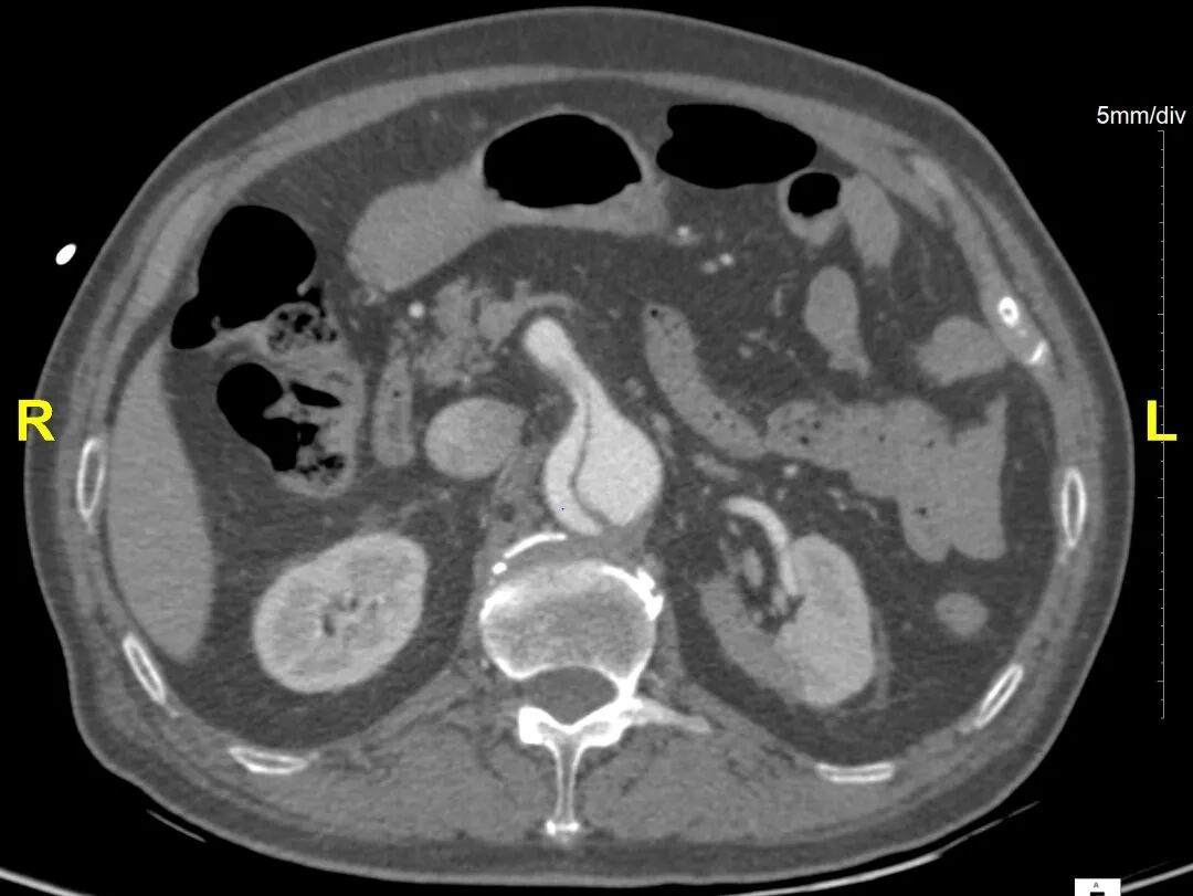 gore医疗怎么样「胸有乾坤」危如累卵 妙手回春——Conformable GORE®TAG®胸主动脉覆膜支架应用于高龄急性主动脉夹层治疗_https://www.jmylbn.com_新闻资讯_第12张