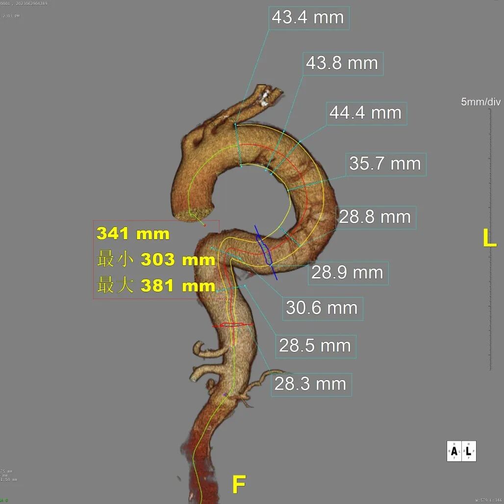 gore医疗怎么样「胸有乾坤」危如累卵 妙手回春——Conformable GORE®TAG®胸主动脉覆膜支架应用于高龄急性主动脉夹层治疗_https://www.jmylbn.com_新闻资讯_第18张