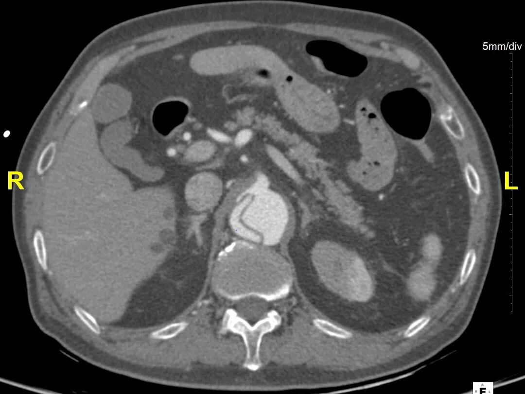 gore医疗怎么样「胸有乾坤」危如累卵 妙手回春——Conformable GORE®TAG®胸主动脉覆膜支架应用于高龄急性主动脉夹层治疗_https://www.jmylbn.com_新闻资讯_第11张