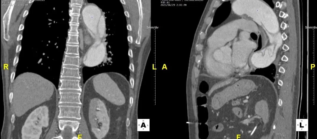 gore医疗怎么样「胸有乾坤」危如累卵 妙手回春——Conformable GORE®TAG®胸主动脉覆膜支架应用于高龄急性主动脉夹层治疗_https://www.jmylbn.com_新闻资讯_第10张
