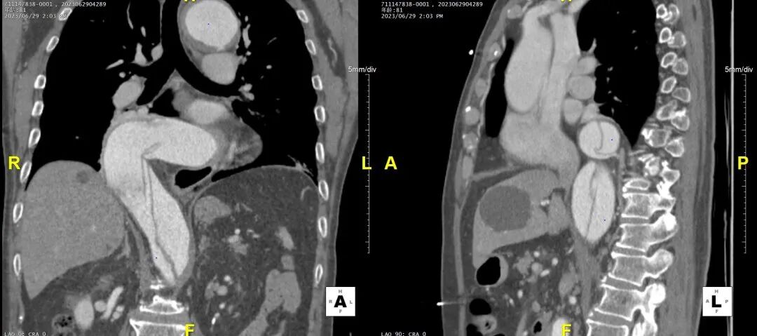 gore医疗怎么样「胸有乾坤」危如累卵 妙手回春——Conformable GORE®TAG®胸主动脉覆膜支架应用于高龄急性主动脉夹层治疗_https://www.jmylbn.com_新闻资讯_第20张
