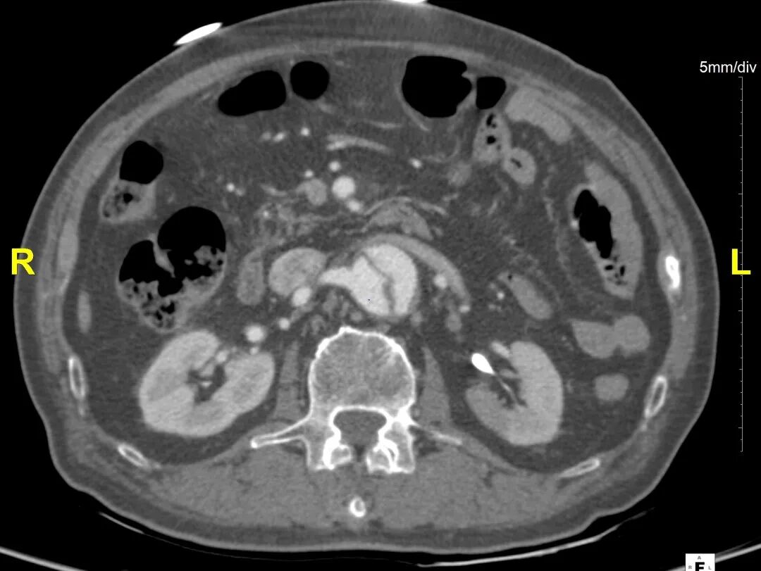 gore医疗怎么样「胸有乾坤」危如累卵 妙手回春——Conformable GORE®TAG®胸主动脉覆膜支架应用于高龄急性主动脉夹层治疗_https://www.jmylbn.com_新闻资讯_第13张