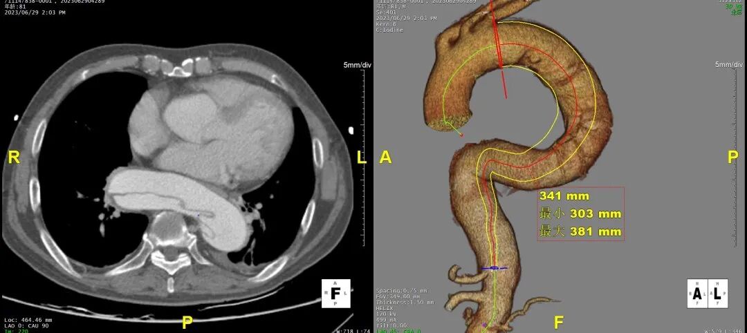 gore医疗怎么样「胸有乾坤」危如累卵 妙手回春——Conformable GORE®TAG®胸主动脉覆膜支架应用于高龄急性主动脉夹层治疗_https://www.jmylbn.com_新闻资讯_第9张