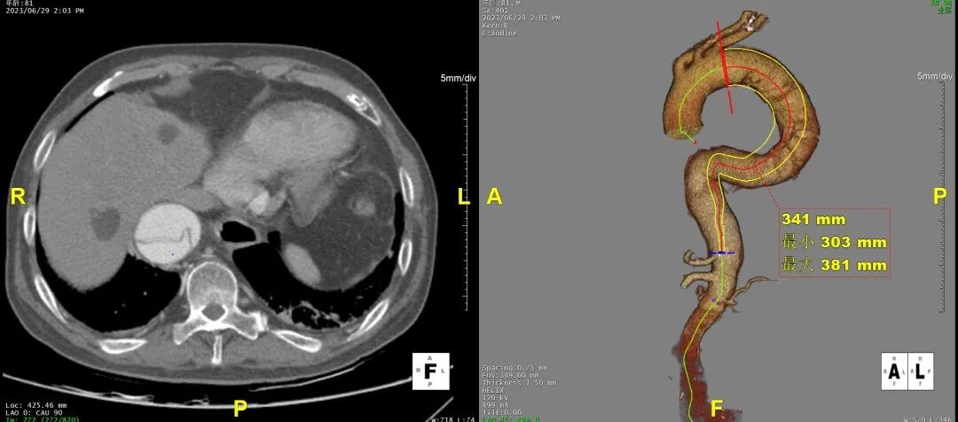 gore医疗怎么样「胸有乾坤」危如累卵 妙手回春——Conformable GORE®TAG®胸主动脉覆膜支架应用于高龄急性主动脉夹层治疗_https://www.jmylbn.com_新闻资讯_第19张