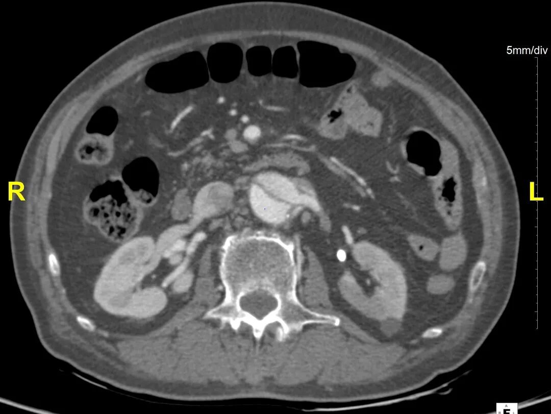 gore医疗怎么样「胸有乾坤」危如累卵 妙手回春——Conformable GORE®TAG®胸主动脉覆膜支架应用于高龄急性主动脉夹层治疗_https://www.jmylbn.com_新闻资讯_第14张