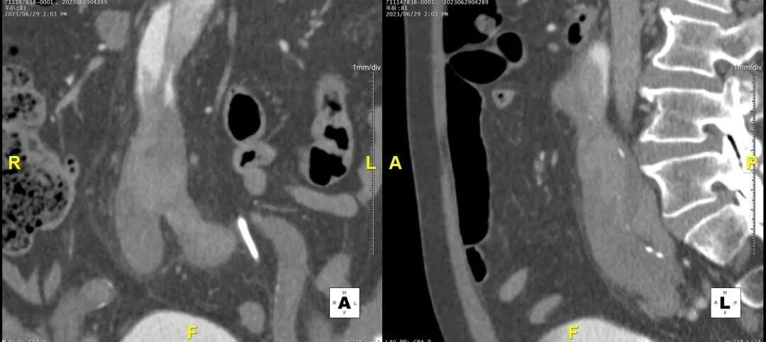 gore医疗怎么样「胸有乾坤」危如累卵 妙手回春——Conformable GORE®TAG®胸主动脉覆膜支架应用于高龄急性主动脉夹层治疗_https://www.jmylbn.com_新闻资讯_第16张