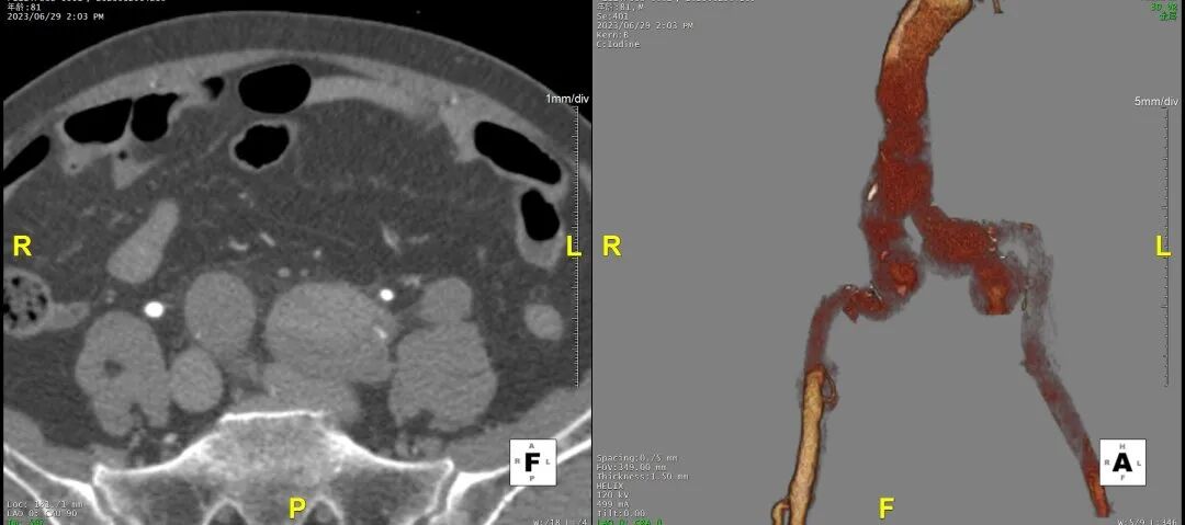 gore医疗怎么样「胸有乾坤」危如累卵 妙手回春——Conformable GORE®TAG®胸主动脉覆膜支架应用于高龄急性主动脉夹层治疗_https://www.jmylbn.com_新闻资讯_第15张