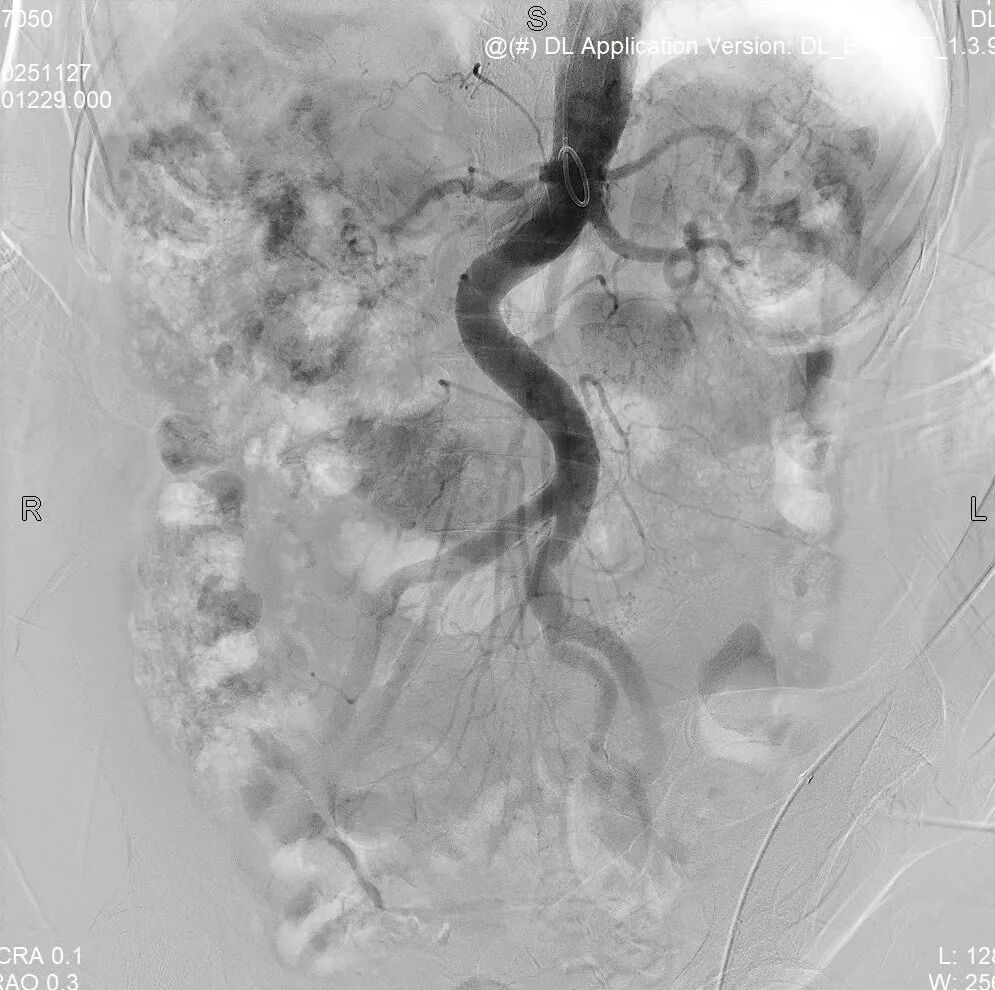 动脉长鞘怎么置入桡胜一筹丨杨敏教授团队：应用Brite Tip Radianz长鞘经远桡动脉治疗肾动脉狭窄一例_https://www.jmylbn.com_新闻资讯_第20张