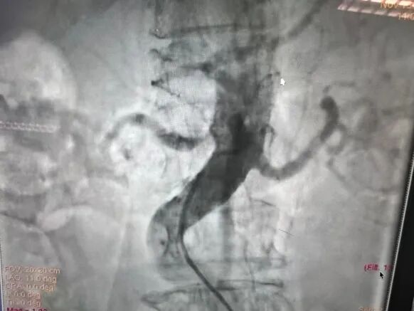 动脉长鞘怎么置入桡胜一筹丨杨敏教授团队：应用Brite Tip Radianz长鞘经远桡动脉治疗肾动脉狭窄一例_https://www.jmylbn.com_新闻资讯_第9张