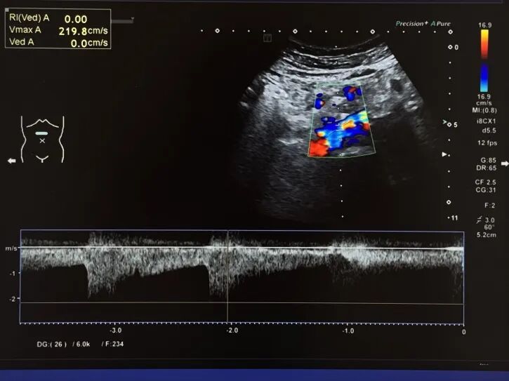动脉长鞘怎么置入桡胜一筹丨杨敏教授团队：应用Brite Tip Radianz长鞘经远桡动脉治疗肾动脉狭窄一例_https://www.jmylbn.com_新闻资讯_第8张
