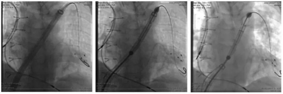 血管鞘组是什么器械百科丨Corpassing泊淮™ 导管鞘组_https://www.jmylbn.com_新闻资讯_第12张