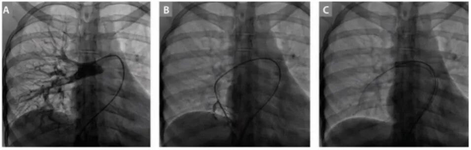 血管鞘组是什么器械百科丨Corpassing泊淮™ 导管鞘组_https://www.jmylbn.com_新闻资讯_第11张