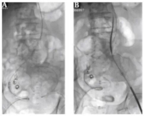 血管鞘组是什么器械百科丨Corpassing泊淮™ 导管鞘组_https://www.jmylbn.com_新闻资讯_第13张
