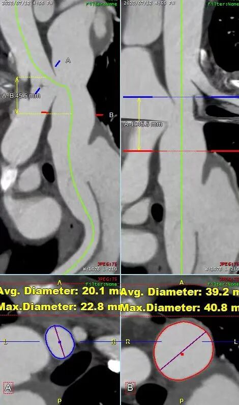 gore医疗怎么样「胸有乾坤」可调可控 精准出击——四川大学华西医院肖正华教授团队：CADS治疗B型主动脉夹层病例分享_https://www.jmylbn.com_新闻资讯_第13张