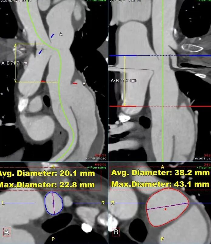 gore医疗怎么样「胸有乾坤」可调可控 精准出击——四川大学华西医院肖正华教授团队：CADS治疗B型主动脉夹层病例分享_https://www.jmylbn.com_新闻资讯_第14张