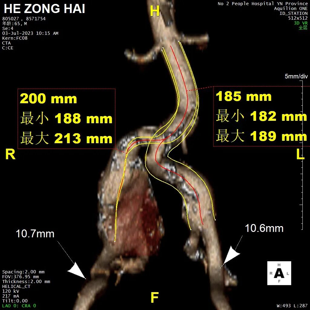 gore医疗怎么样「漫腹精论」双股动脉入路，纯腔内保双髂——GORE® EXCLUDER® 髂动脉分支型覆膜支架（IBE）治疗双侧髂总动脉_https://www.jmylbn.com_新闻资讯_第7张