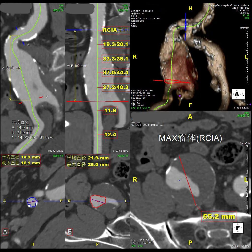 gore医疗怎么样「漫腹精论」双股动脉入路，纯腔内保双髂——GORE® EXCLUDER® 髂动脉分支型覆膜支架（IBE）治疗双侧髂总动脉_https://www.jmylbn.com_新闻资讯_第10张