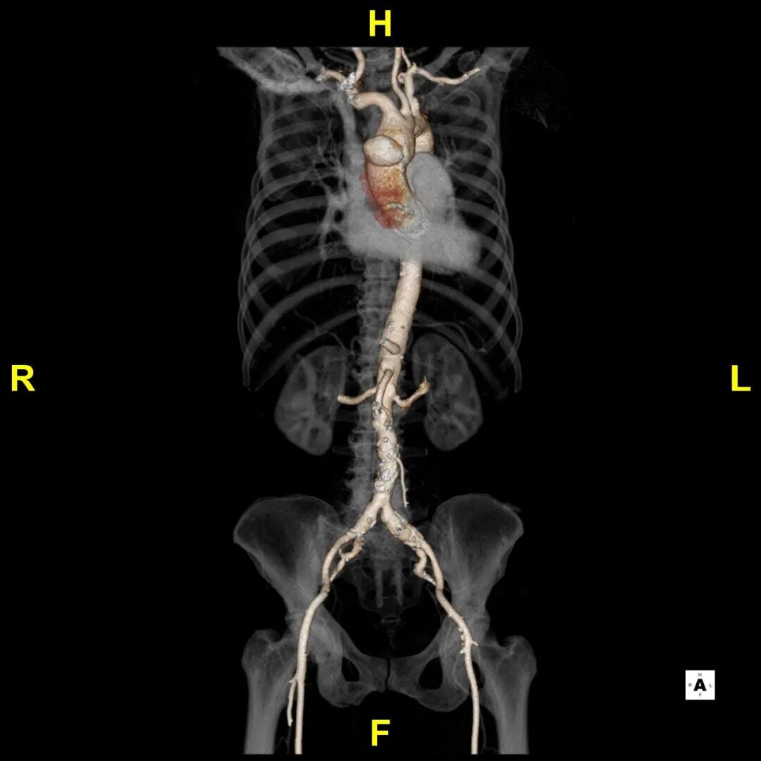 gore医疗怎么样「胸有乾坤」异“区”同“功” 精准定位——GORE® TAG® 可主动调控胸主动脉覆膜支架治疗升主动脉穿透性溃疡病例报道_https://www.jmylbn.com_新闻资讯_第11张