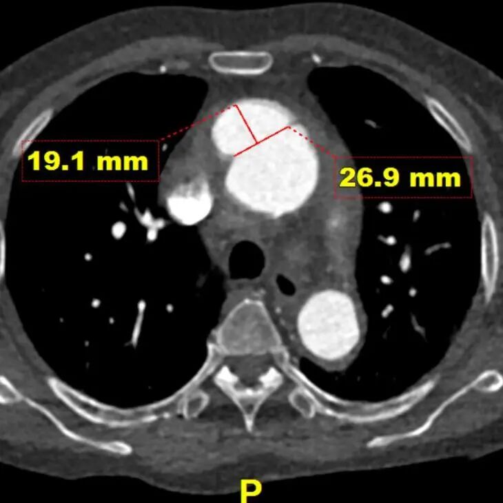 gore医疗怎么样「胸有乾坤」异“区”同“功” 精准定位——GORE® TAG® 可主动调控胸主动脉覆膜支架治疗升主动脉穿透性溃疡病例报道_https://www.jmylbn.com_新闻资讯_第9张