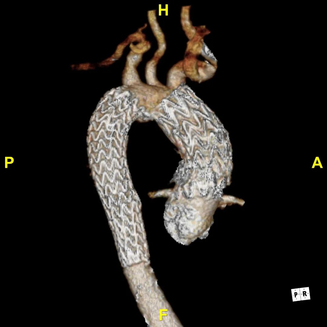 gore医疗怎么样「胸有乾坤」异“区”同“功” 精准定位——GORE® TAG® 可主动调控胸主动脉覆膜支架治疗升主动脉穿透性溃疡病例报道_https://www.jmylbn.com_新闻资讯_第22张