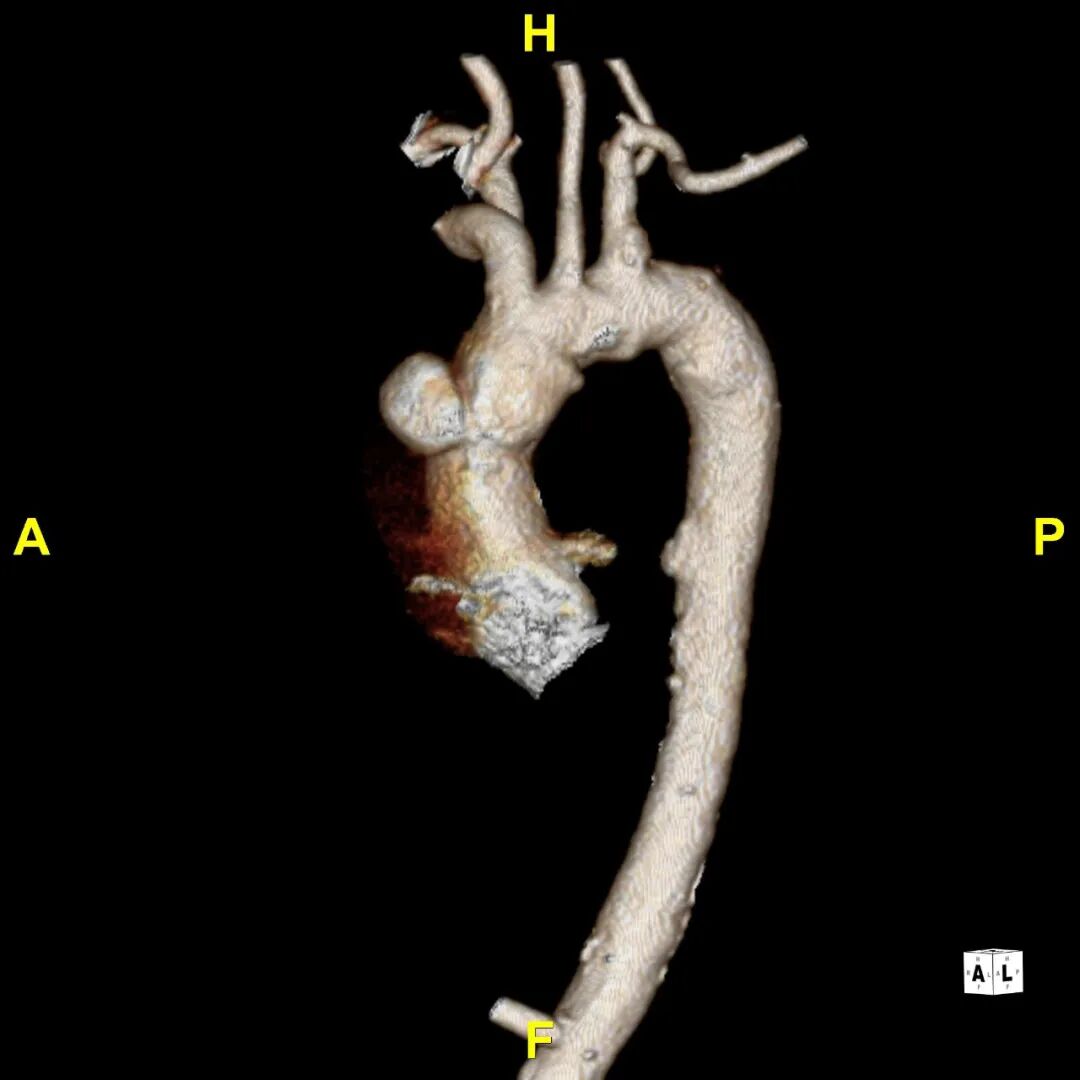 gore医疗怎么样「胸有乾坤」异“区”同“功” 精准定位——GORE® TAG® 可主动调控胸主动脉覆膜支架治疗升主动脉穿透性溃疡病例报道_https://www.jmylbn.com_新闻资讯_第12张