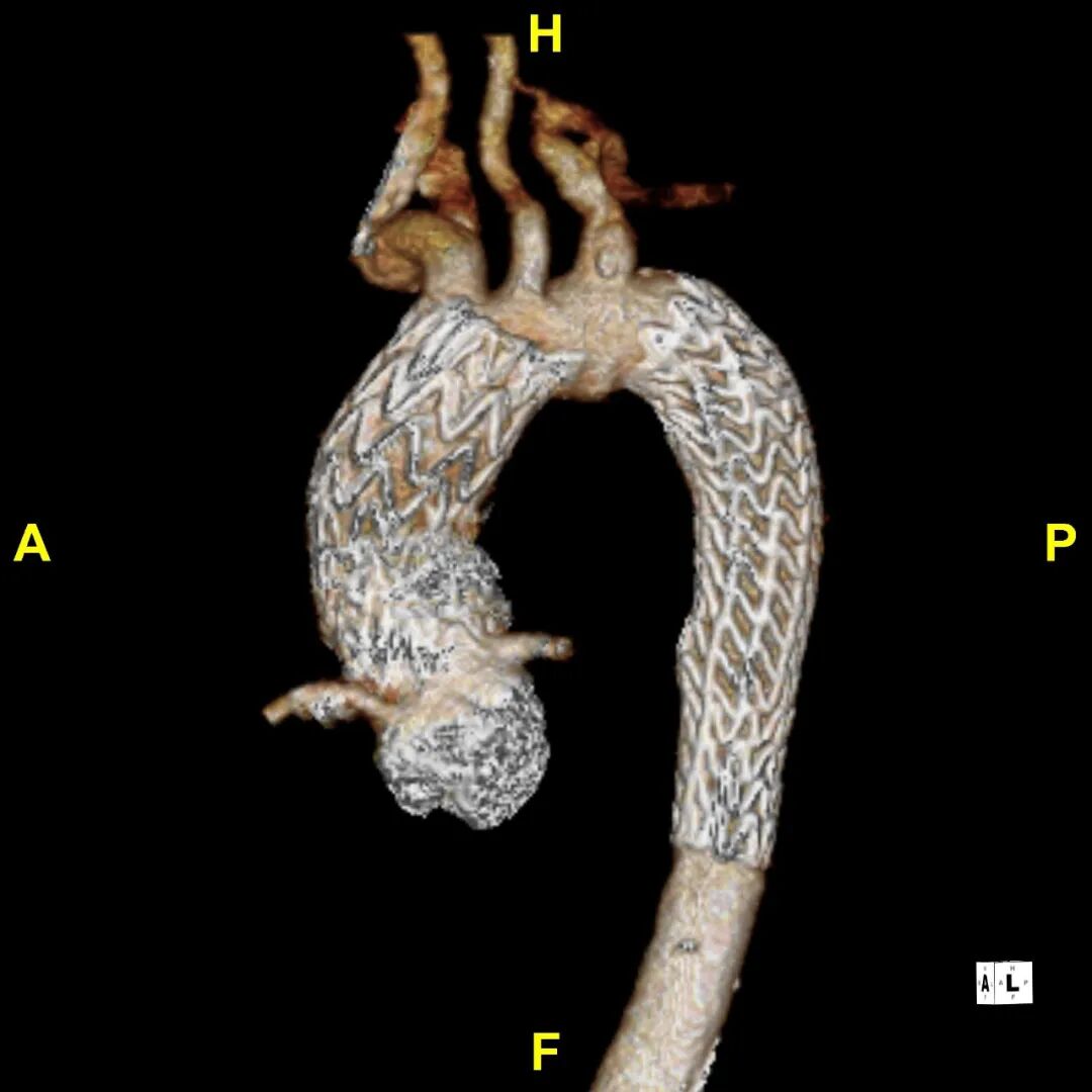 gore医疗怎么样「胸有乾坤」异“区”同“功” 精准定位——GORE® TAG® 可主动调控胸主动脉覆膜支架治疗升主动脉穿透性溃疡病例报道_https://www.jmylbn.com_新闻资讯_第23张