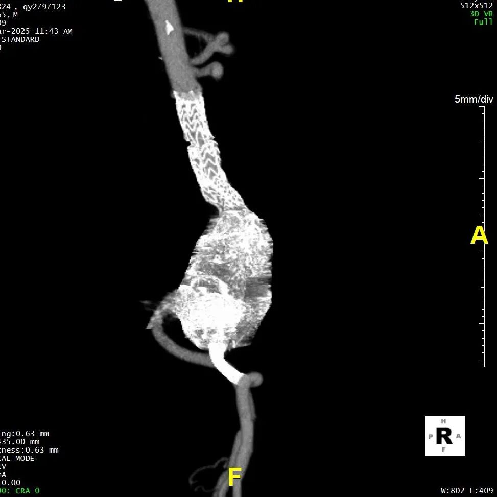 gore医疗怎么样「漫腹精论」髂合时宜 精益求精——双MOB球囊导管辅助腹主动脉覆膜支架急诊治疗破裂巨大髂动脉瘤_https://www.jmylbn.com_新闻资讯_第33张