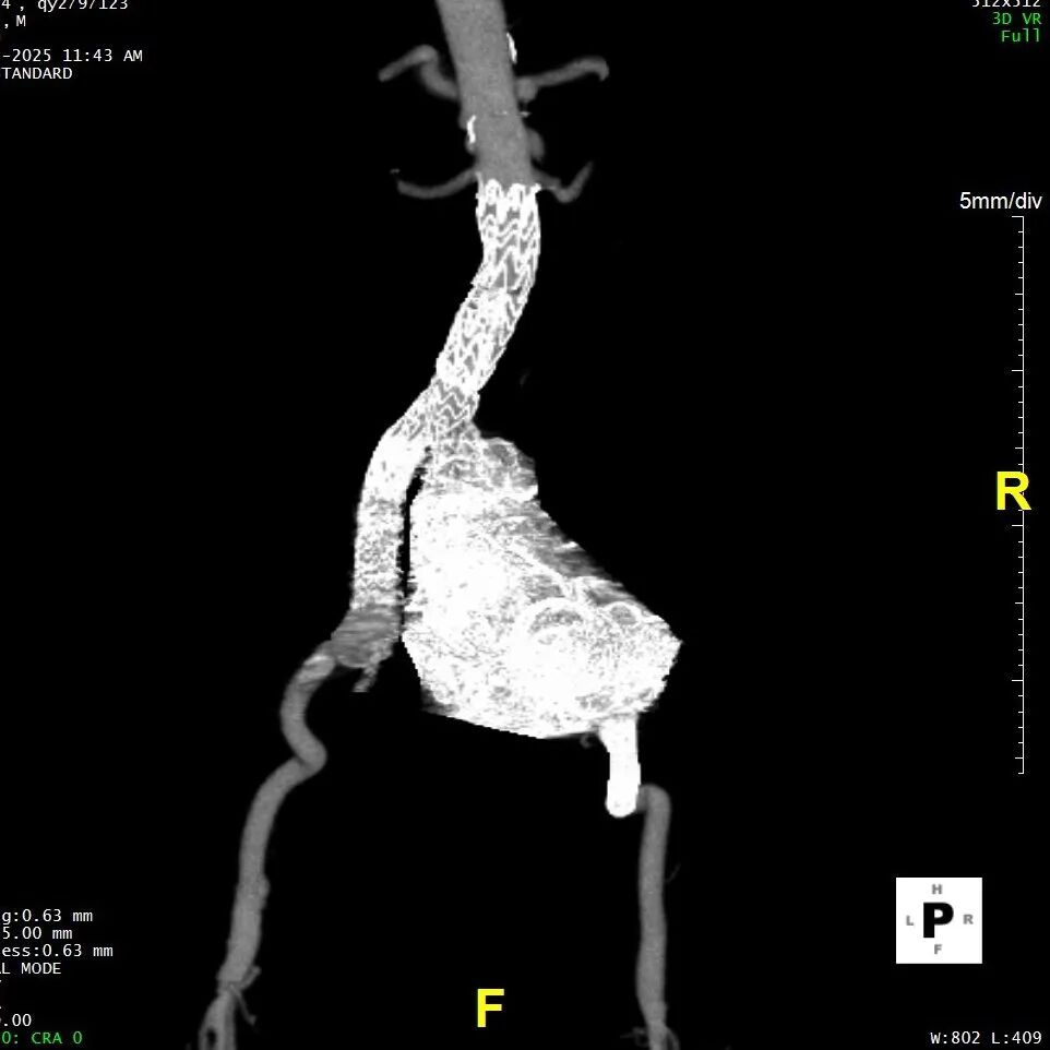 gore医疗怎么样「漫腹精论」髂合时宜 精益求精——双MOB球囊导管辅助腹主动脉覆膜支架急诊治疗破裂巨大髂动脉瘤_https://www.jmylbn.com_新闻资讯_第34张