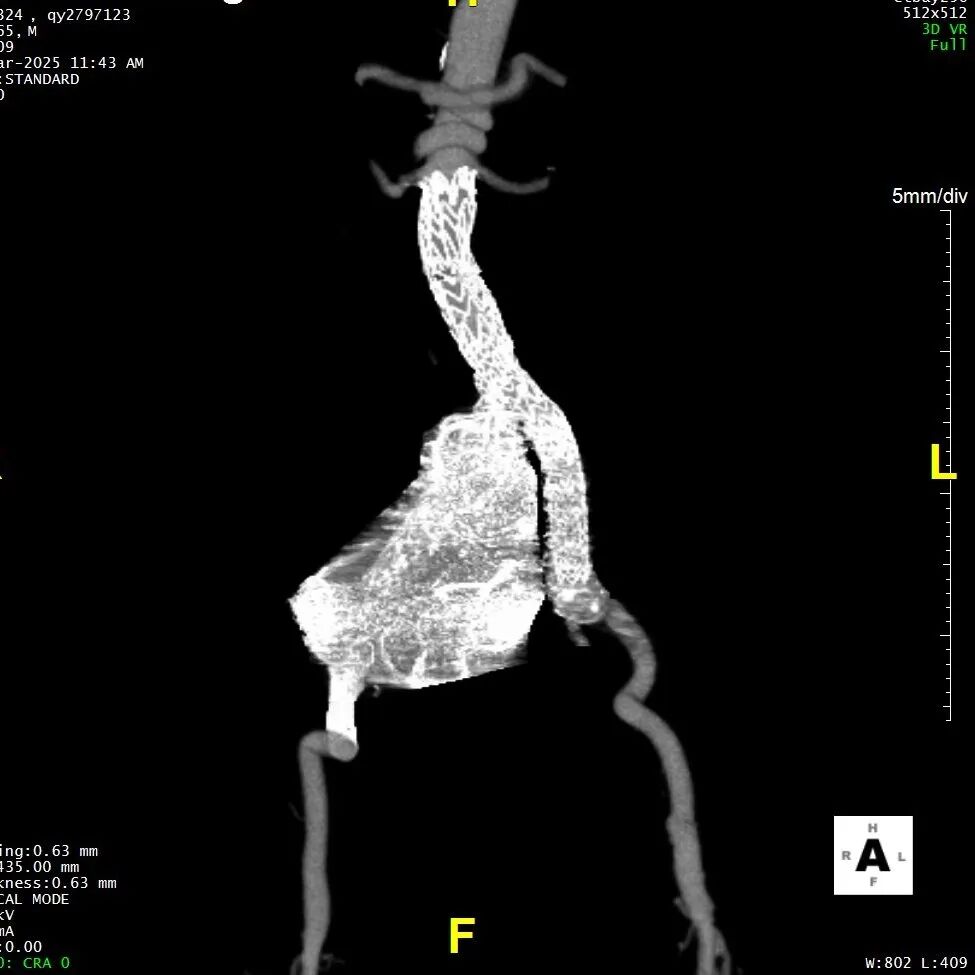 gore医疗怎么样「漫腹精论」髂合时宜 精益求精——双MOB球囊导管辅助腹主动脉覆膜支架急诊治疗破裂巨大髂动脉瘤_https://www.jmylbn.com_新闻资讯_第31张