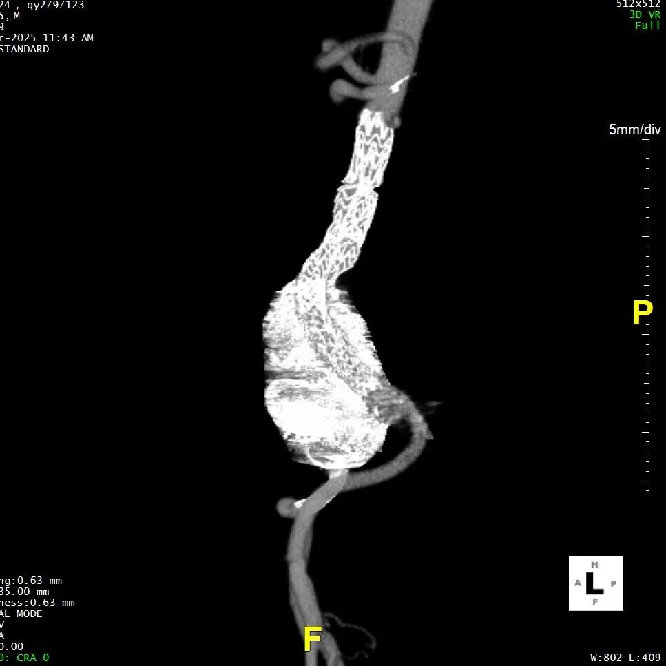 gore医疗怎么样「漫腹精论」髂合时宜 精益求精——双MOB球囊导管辅助腹主动脉覆膜支架急诊治疗破裂巨大髂动脉瘤_https://www.jmylbn.com_新闻资讯_第32张