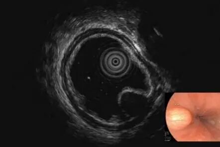 b超md是什么意思【红星科普】当胃镜遇上B超：揭秘身体里的“透视侦探”——超声内镜_https://www.jmylbn.com_新闻资讯_第5张