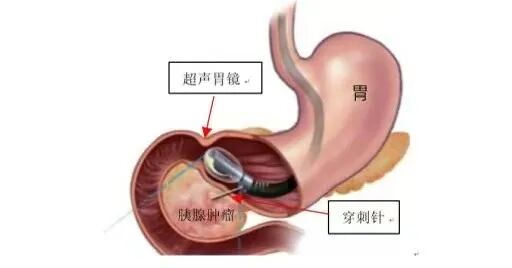 b超md是什么意思【红星科普】当胃镜遇上B超：揭秘身体里的“透视侦探”——超声内镜_https://www.jmylbn.com_新闻资讯_第6张