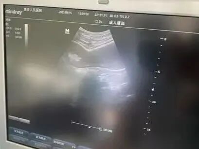 洗胃去什么科【红星科普】让超声引导下洗胃技术与传统盲洗胃说“拜拜”！_https://www.jmylbn.com_新闻资讯_第13张