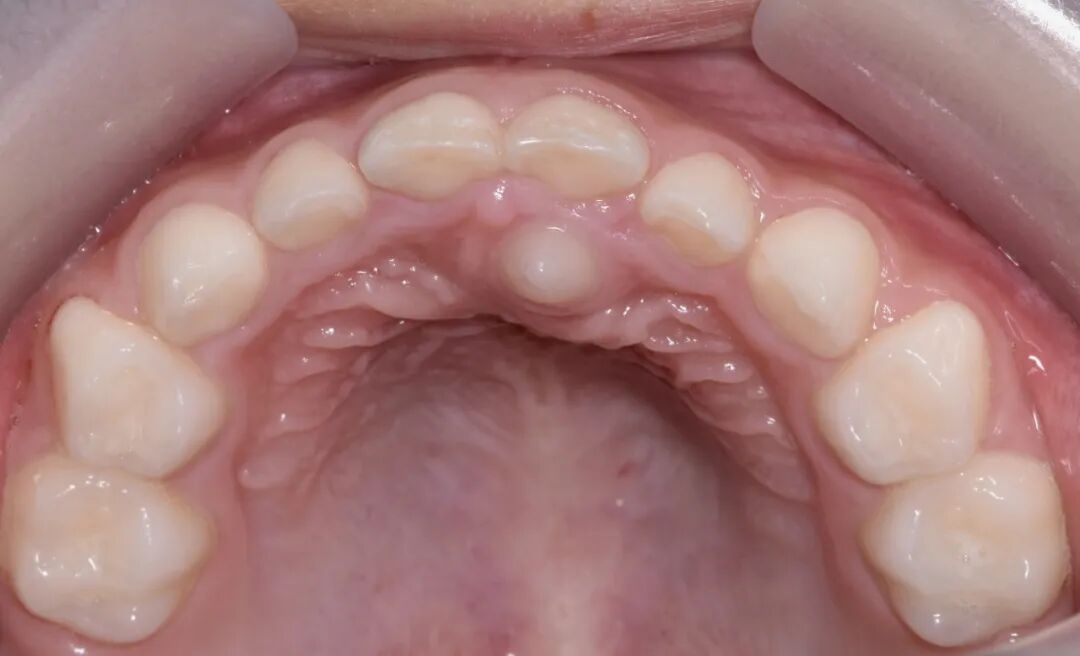 曲面断层片怎么看换牙与身高有关吗？关于孩子换牙的所有疑问一篇说清_https://www.jmylbn.com_新闻资讯_第18张