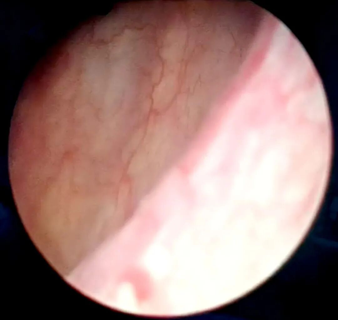 医讯怎么用『附一医讯』频繁血尿，一查竟是高危膀胱癌，福医附一医院泌尿外科新诊疗模式助力 “膀胱保卫战”，不用切除膀胱也能治愈肿瘤_https://www.jmylbn.com_新闻资讯_第10张