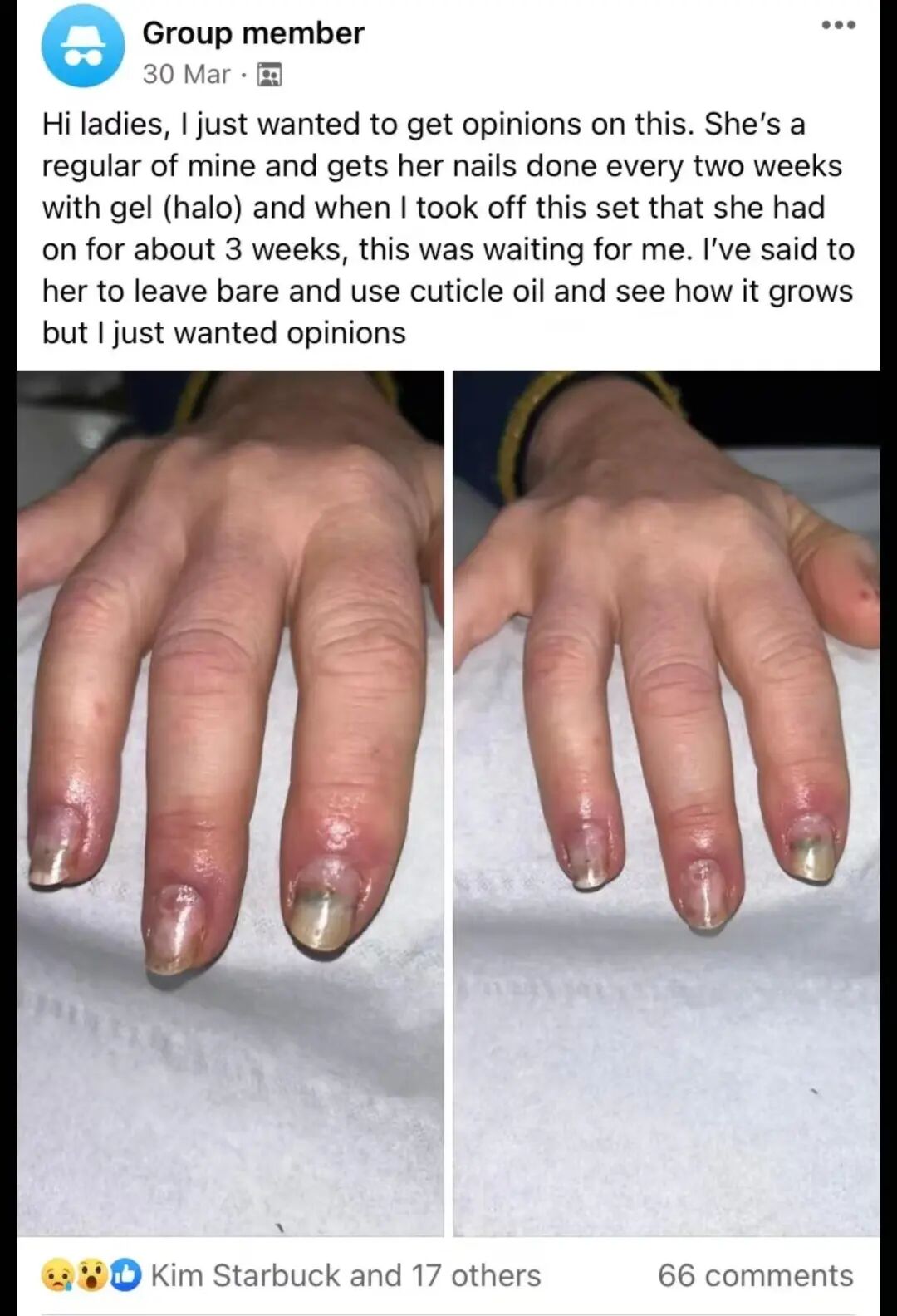 牙科光固化机是什么光患者齿科术后突发过敏，竟是美甲惹的祸？！_https://www.jmylbn.com_新闻资讯_第3张