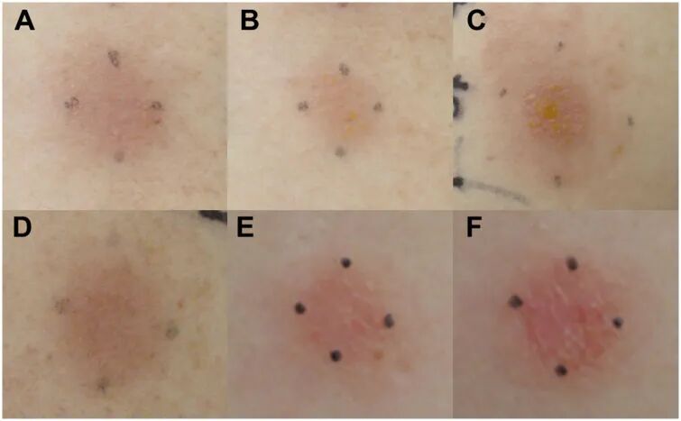 牙科光固化机是什么光患者齿科术后突发过敏，竟是美甲惹的祸？！_https://www.jmylbn.com_新闻资讯_第10张