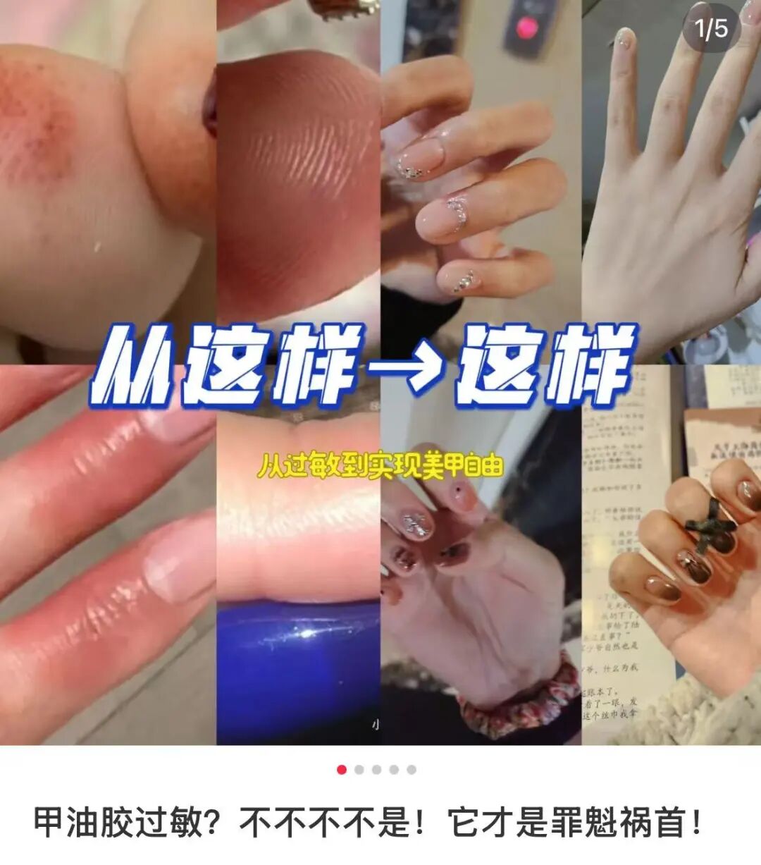 牙科光固化机是什么光患者齿科术后突发过敏，竟是美甲惹的祸？！_https://www.jmylbn.com_新闻资讯_第4张